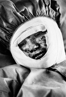 Burn Centre, Regional Hospital, a self-immolated woman, 2010