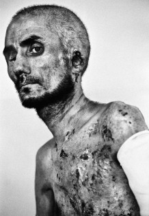 Burn Centre, one of the two self-immolated men of the year, 2010