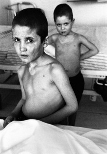 Burn Centre, Saifallah and Mannak, two of six brothers victims of an explosion in Helmand Province, 2010