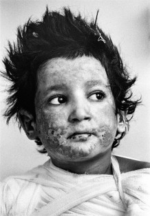 Burn Centre, Said Ahmad, the third of six brothers victims of an explosion in Helmand Province, 2010
