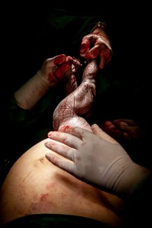 EMERGENCY's Maternity Centre, operating room, caesarean section, 2019.