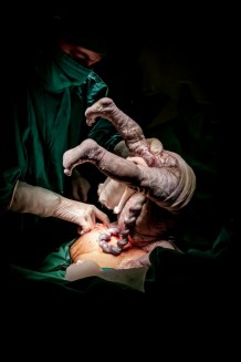 EMERGENCY's Maternity Centre, operating room, 2019. Birth of Kemeya’s daughter, by caesarean section. Kemeya is 36 years old; it is her fifth caesarean section.